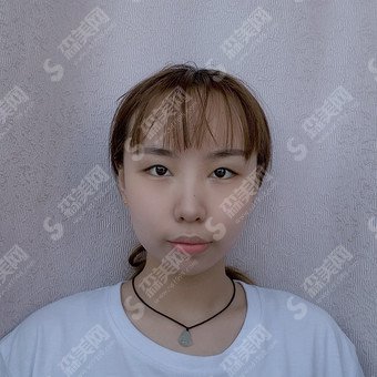 割双眼皮的价目一览表2020,割双眼皮怎么样?内含个双眼皮的手术果恢复图