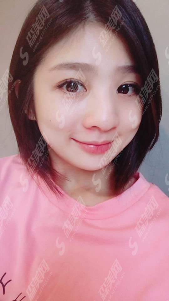 玻尿酸隆鼻整形价目表2020,玻尿酸隆鼻整形怎么样?内含玻尿酸隆鼻的果恢复图