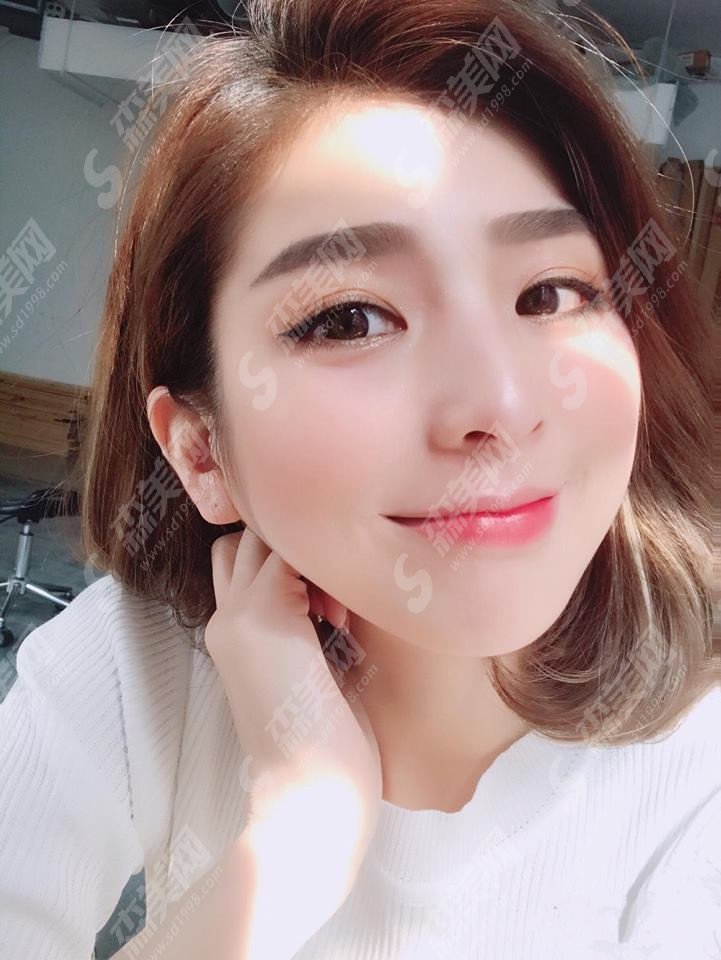 玻尿酸隆鼻整形价目表2020,玻尿酸隆鼻整形怎么样?内含玻尿酸隆鼻的果恢复图