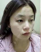 北京协和医院整形科价目表2021，内含做双眼皮的案例果比对