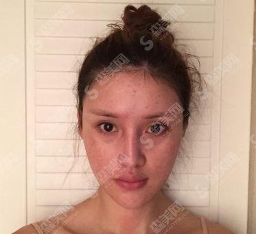 沈阳杏林整形医院价格表2021，附唇部整形案例真实果