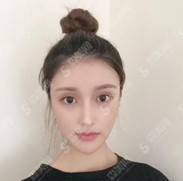 沈阳杏林整形医院价格表2021，附唇部整形案例真实果