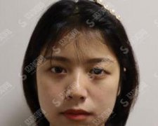 南充阿蓝整形医院价目表2021，内含双眼皮案例果图对比