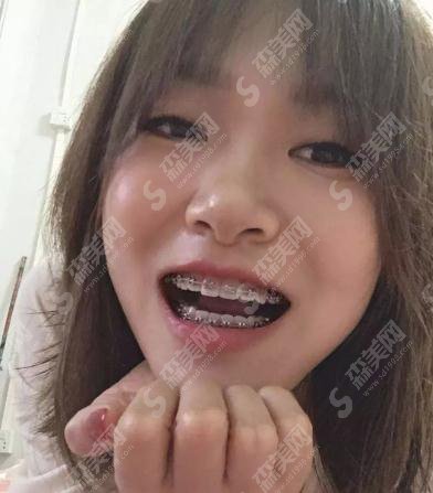 上海九院口腔科价目表2021,内含汪勇正畸案例前后对比图