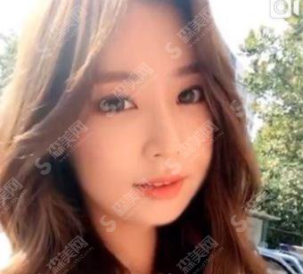 南宁熠美整形价目表2021，内含面部吸脂果图对比