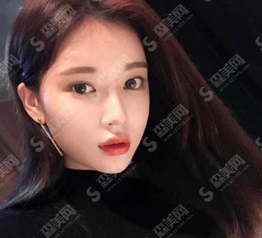 南宁熠美整形价目表2021，内含面部吸脂果图对比