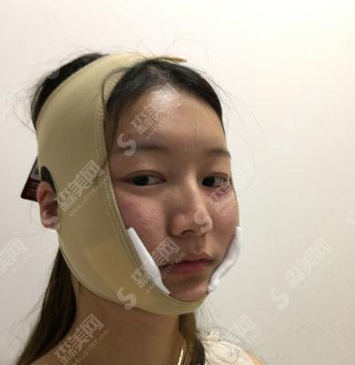 成都军大整形美容医院价目表2021,内含下颌角整形案例果图