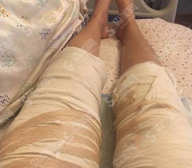 柏盛医疗整形价目表2021，内含大腿吸脂的具体恢复记录