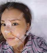 上海九院微整形价格表2021，内含鼻部综合术恢复过程图