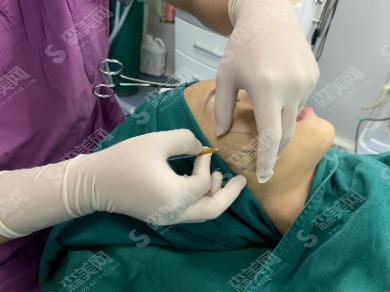 整形医生顾浩埋线提升技术做的如何?徐州华美整形医院/口碑怎么样/案例展示