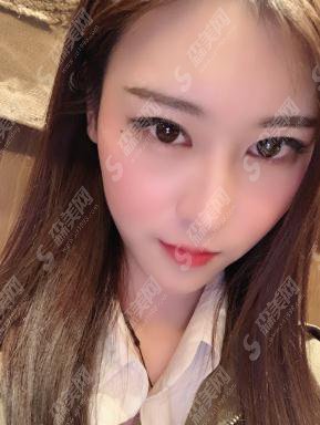 整形医生顾浩埋线提升技术做的如何?徐州华美整形医院/口碑怎么样/案例展示