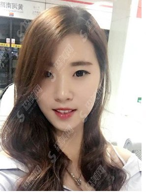 北京八大处做的双眼皮怎么样?附医院简介/案例分享/注意事项