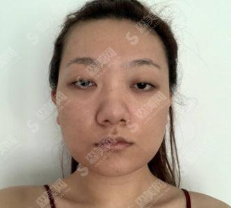 李战强医生耳软骨隆鼻技术好不好?深圳市美莱医疗美容医院/口碑如何/案例展示