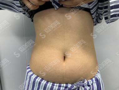 秦皇岛巧致整形价格表2021,内含腰腹吸脂术后的恢复情况