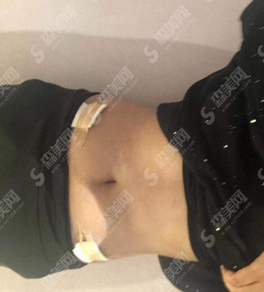 秦皇岛巧致整形价格表2021,内含腰腹吸脂术后的恢复情况