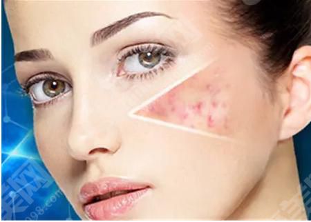 什么是激光祛痘印？,激光祛痘印价格是多少?附祛痘印价格及案例