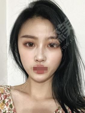沈阳杏林医院怎么样？沈阳杏林医院做的双眼皮果怎么样？附医师介绍及案例分享
