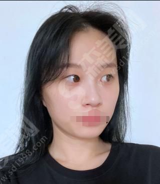 沈阳杏林医院怎么样？沈阳杏林医院做的双眼皮果怎么样？附医师介绍及案例分享