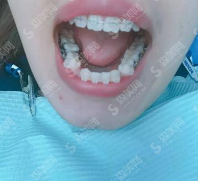 毕节京州口腔医院价目表2021，内号牙齿矫正具体的果