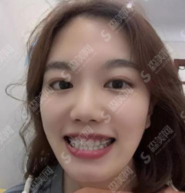 毕节京州口腔医院价目表2021，内号牙齿矫正具体的果