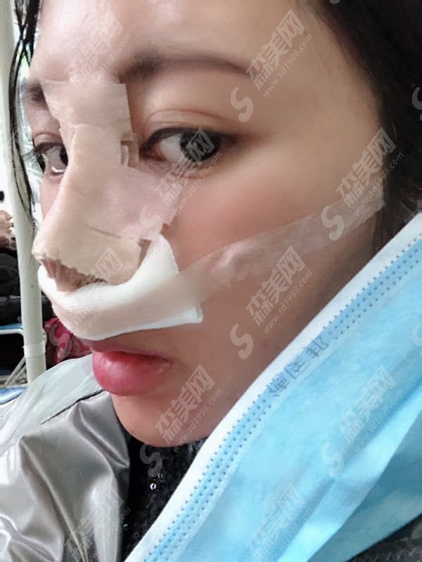 西京医院隆鼻医生那个好?技术口碑怎么样?内附隆鼻整形的案例果图