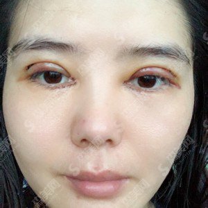 西京医院哪位医生做双眼皮做的好?双眼皮医生一览&内附马显杰医生的双眼皮案例