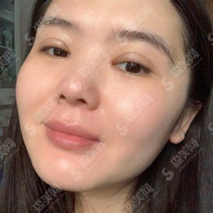 西京医院哪位医生做双眼皮做的好?双眼皮医生一览&内附马显杰医生的双眼皮案例