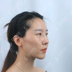 西安西京医院怎么样？西安西京医院介绍/面部填充的方案设计/面部填充的术后果