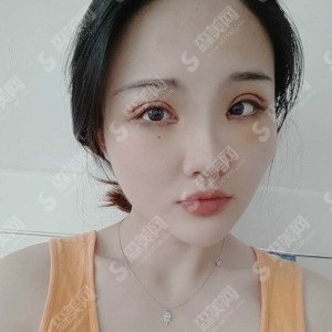 西京医院哪位医生修复双眼皮儿做得好?医生介绍一览@内附鲁开化医生双眼皮修复案例