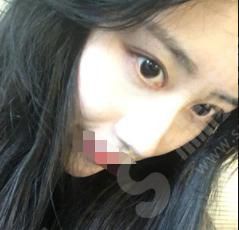 济南旭美整形医院怎么样？济南旭美整形做的双眼皮怎么样？附医师介绍及案例分享
