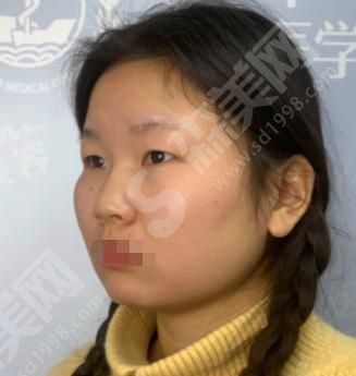 汉密尔顿美容医院怎么样?汉密顿美容医院做的双眼皮怎么样?附医师介绍及案例分享