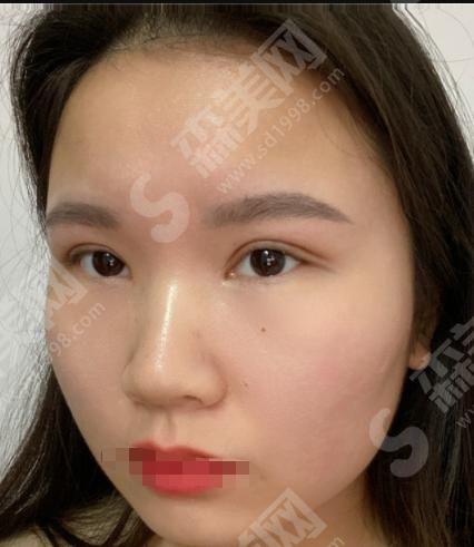 汉密尔顿美容医院怎么样?汉密顿美容医院做的双眼皮怎么样?附医师介绍及案例分享