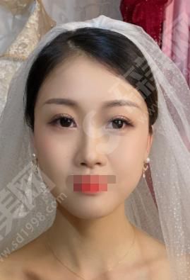 全国前10名整形医院有哪些？广州曙光医院做的双眼皮果如何？附医院介绍及案例分享