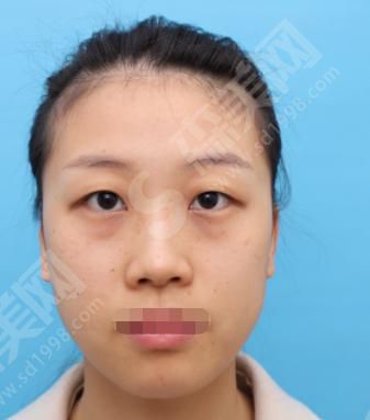 全国前10名整形医院有哪些？广州曙光医院做的双眼皮果如何？附医院介绍及案例分享