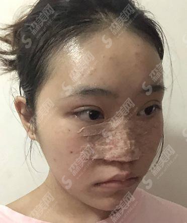 成都铜雀台整形医院价格表2021,附隆鼻的全恢复照片