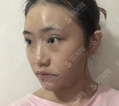 成都铜雀台整形医院价格表2021,附隆鼻的全恢复照片