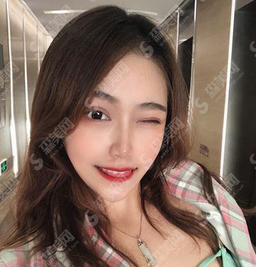 成都铜雀台整形医院价格表2021,附隆鼻的全恢复照片