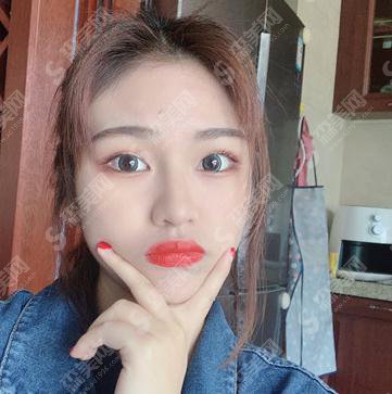 长春中研美容院价目表2021，内含面部吸脂恢复记录