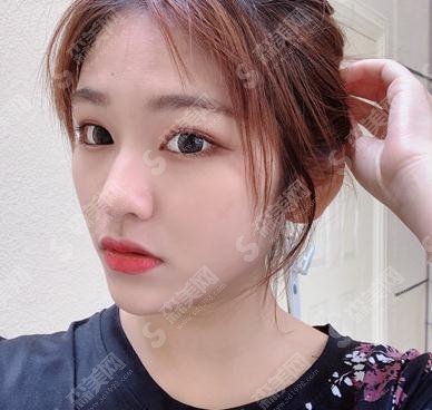 长春中研美容院价目表2021，内含面部吸脂恢复记录