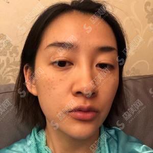 南宁西京医院激光祛斑的整形价目表2020,激光祛斑的治疗怎么样？内附激光祛斑的整形修复案例对比