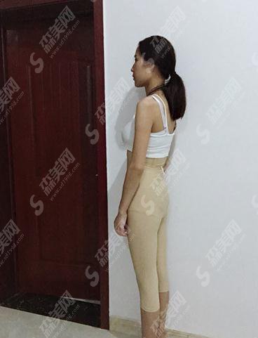 南昌亚太整形价目表2021,内含全身吸脂真实案例,术后恢复分享