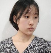 驻马店缔莱美正规吗？2021价目表公布，内含内切去眼袋恢复过程