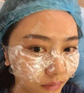 湘雅三医院激光美肤的价格?内含激光美肤案例果展示图