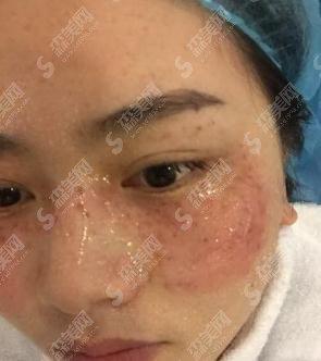 湘雅三医院激光美肤的价格?内含激光美肤案例果展示图