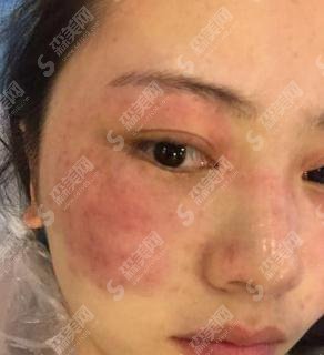 湘雅三医院激光美肤的价格?内含激光美肤案例果展示图