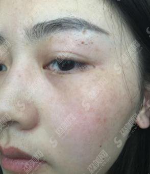 湘雅三医院激光美肤的价格?内含激光美肤案例果展示图