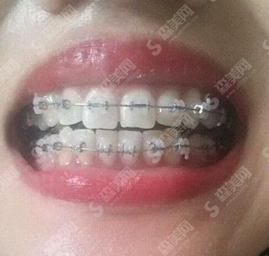 丁建宇医生矫正牙齿专业吗?长沙中诺口腔医院/口碑如何/案例展示