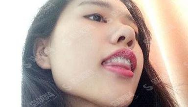 丁建宇医生矫正牙齿专业吗?长沙中诺口腔医院/口碑如何/案例展示