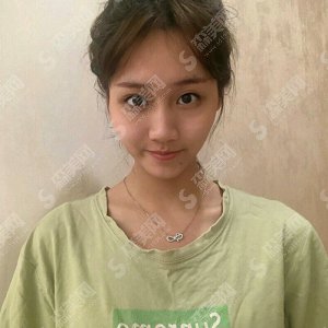 保定正规的三甲整容医院有哪些?河北医科大学附属医院/郭文哲医生/脂肪面部填充案例