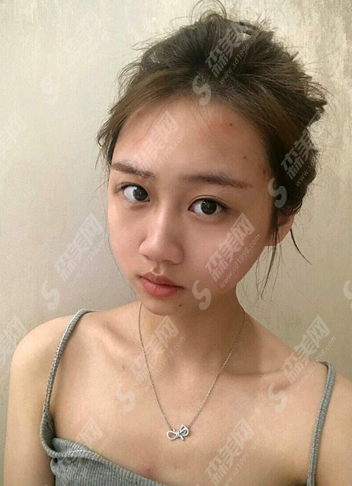 保定正规的三甲整容医院有哪些?河北医科大学附属医院/郭文哲医生/脂肪面部填充案例